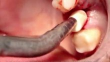 EXPERTS ARE CLUELESS ABOUT IMMEDIATE ANATOMIC ZIRCONIA  UPPER MOLAR IMPLANT METHOD,