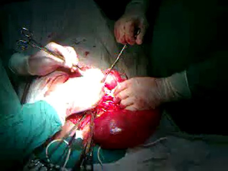 Volvulus du sigmoide