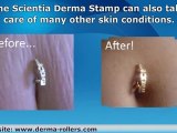 Derma Stamp for Stretch Marks Removal