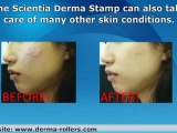 Derma Stamp for Acne Scars Treatment