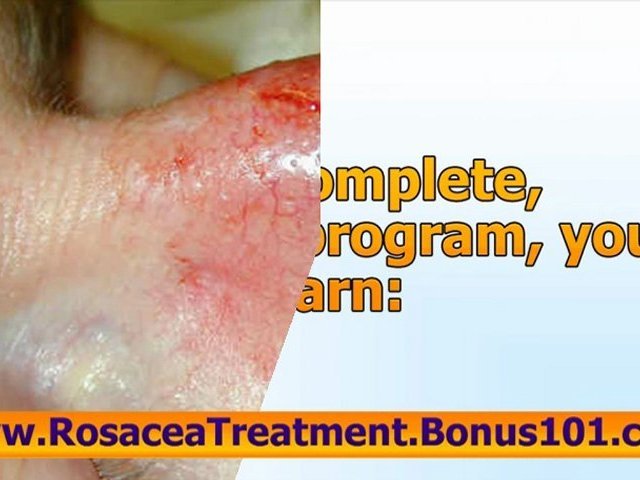 rosacea natural treatment – treatment for rosacea – acne rosacea treatment