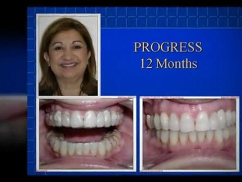Invisalign Prices start at $2900 with Dr. Marino in Vacaville
