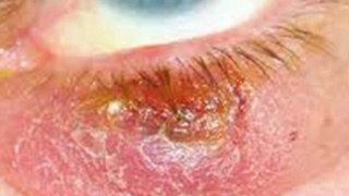 treatment rosacea - treatment of rosacea - rosacea home remedies