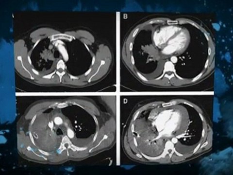 Asbestos Hoffman Estates