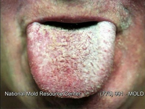 Symptoms of Mold Exposure Mold Sickness Mold Exposure Symptoms