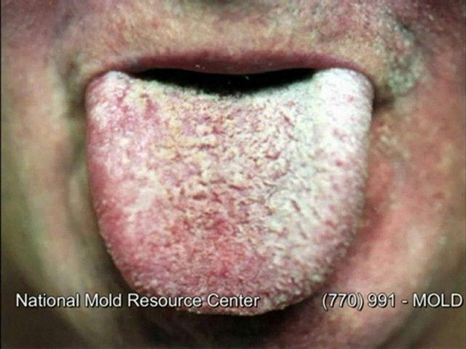 Symptoms of Mold Exposure Mold Sickness Mold Exposure Symptoms
