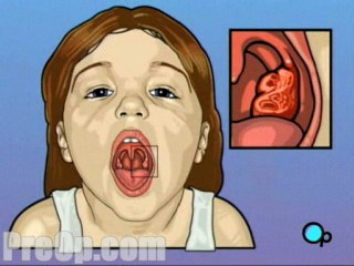 Tonsillectomy - Body