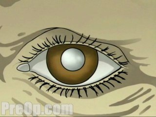 Large Incision Cataract - Body