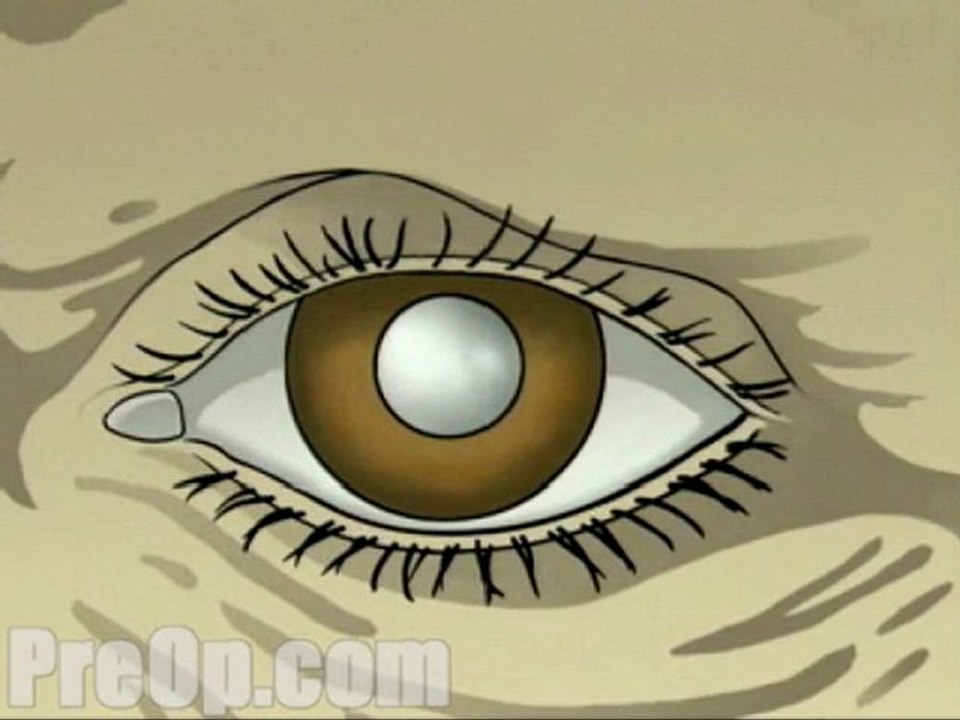 Large Incision Cataract - Body