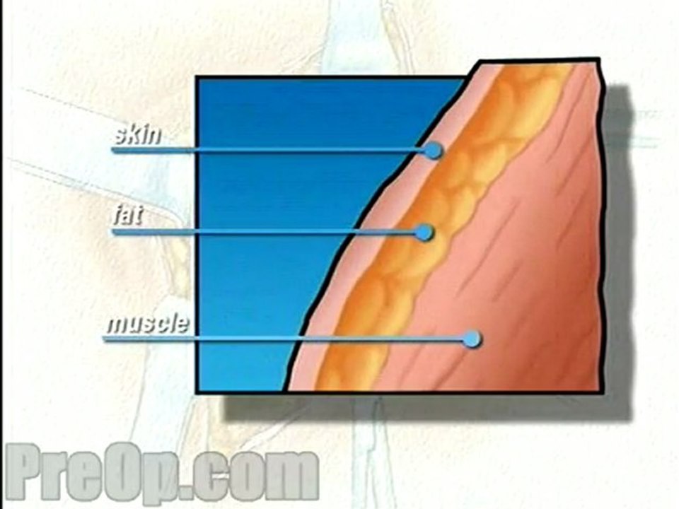 General Biopsy Surgery, Body