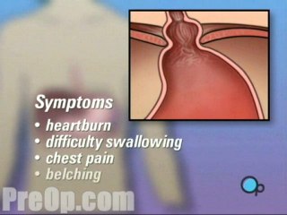 Hernia Hiatal Laparoscopic - Body