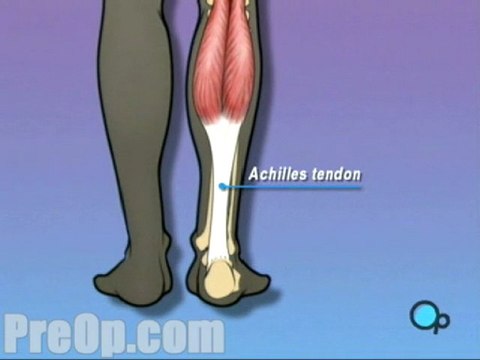 Achilles Tendon Repair Surgery - Body