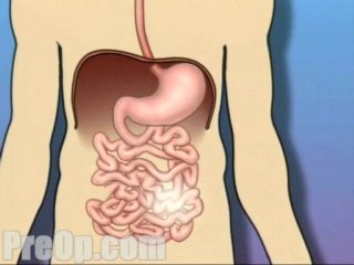 Endoscopy - Upper GI - Body