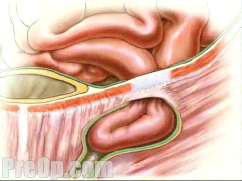 Hernia Repair Inguinal (Laparoscopic) - Body