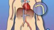 Cardiac Catheterization Angiography - Body