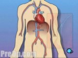 Balloon Angioplasty Coronary Angioplasty - Body