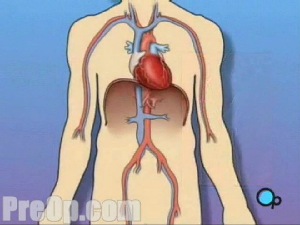 Stent Implantation Coronary Angioplasty - Body