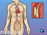 Coronary Artery Bypass Graft (CABG) Surgery - Body