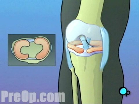 Anterior Cruciate Ligament Arthroscopic Repair Surgery - Body