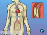 Coronary Artery Bypass Graft (CABG off-pump) - Body