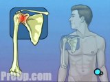 Shoulder Replacement - Body