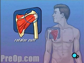 Rotator Cuff Repair - Arthroscopic - Body