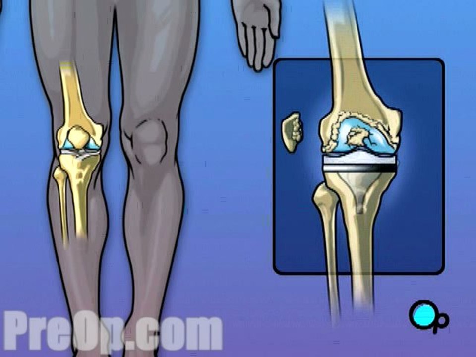 Knee Replacement Surgery - Body