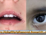 how to get rid of a wart - home remedies for warts - how to get rid of warts on hands
