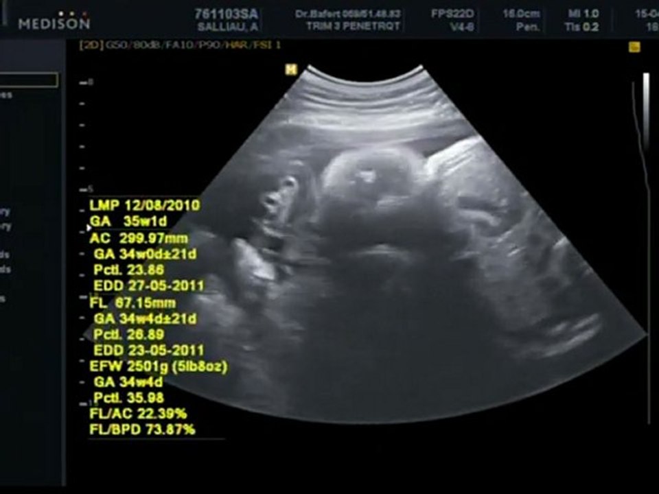 echographie 15/04/2011