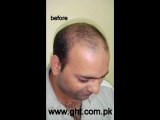 hair transplant cost in pakistan,hair transplant in pakistan,FUE clinics pakistan