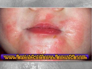 cold sore remedies - cold sore treatment - cold sore cures