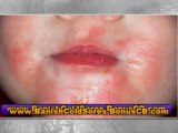 cold sore home remedies - how to treat cold sores - how to treat a cold sore
