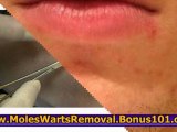 skin tag removal at home - how to get rid of skin tags - skin tags how to remove