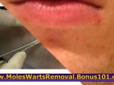 skin tag removal home remedy - how to get rid of skin tags at home - skin tags removal at home