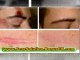 chicken pox scar - chicken pox scars - reduce acne scars - acne scars removal