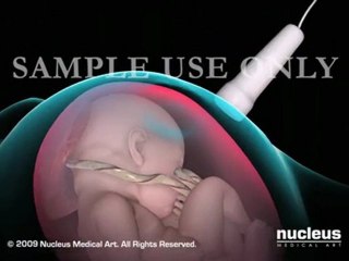 Amniocentesis: Amniotic Fluid Test in Pregnancy