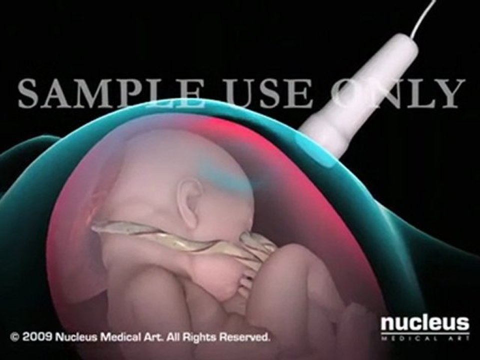 Amniocentesis: Amniotic Fluid Test in Pregnancy