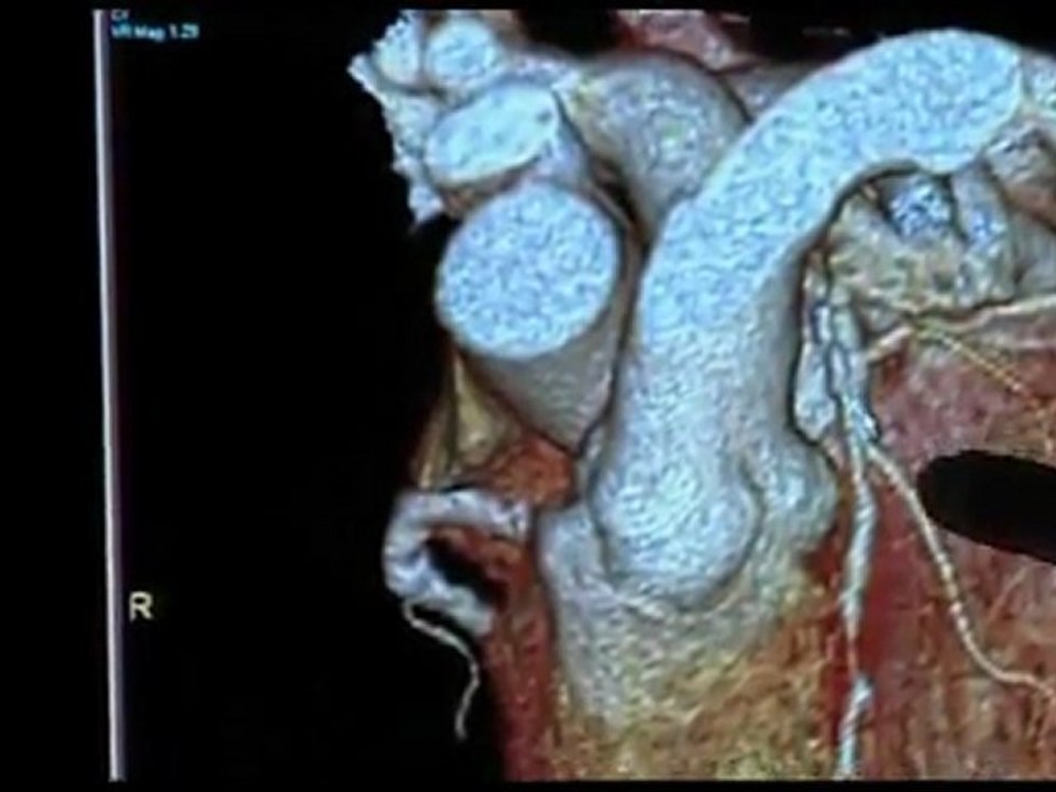 Cardiac CT Angiography Program