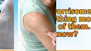 how to remove a skin tag yourself - skin tags home remedies - removing skin tags at home