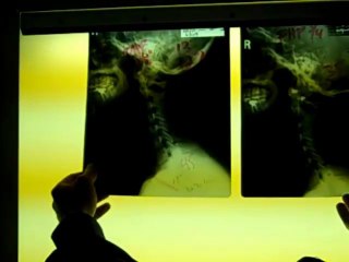 Scoliosis Progress
