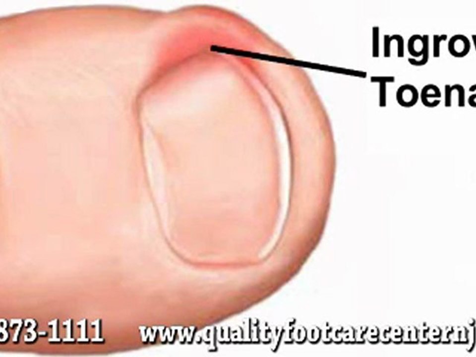 Ingrown Toenails - Somerset, NJ Podiatrist