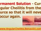 cheilitis treatment - angular cheilitis remedy - how to treat angular cheilitis