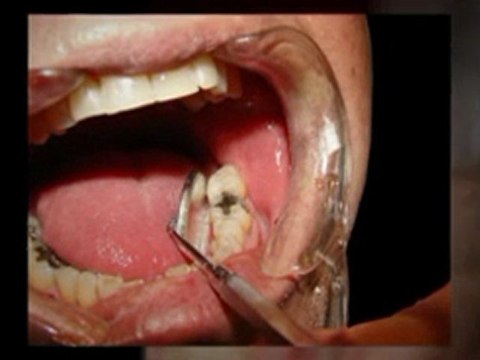 7 Day Dental in Anaheim is Now Using Lasers for Dental Care and Cleaning