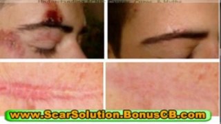 treatment for scars - treating acne scars - how to remove scars