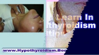 natural cures for hypothyroidism - hypothyroidism natural treatment