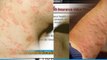 how to get rid of hives fast - treatment for hives in adults