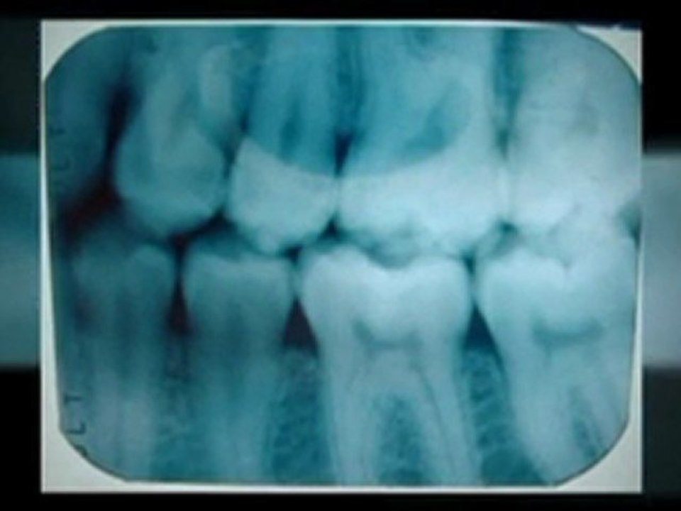 See How Dental Implants in Laguna Can Change Your Life Before Turning to Dentures