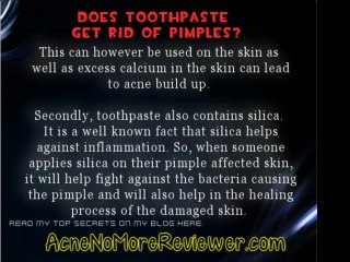 Does Toothpaste Get Rid of Pimples