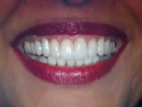 Crooked teeth -Veneers Austin,Tx-Lakeway Before an