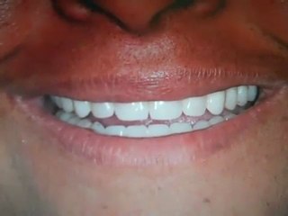 Dentures Austin, Tx- Lakeway Before and after Phot